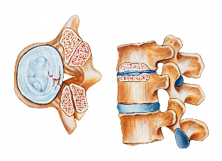 Osteokondroz