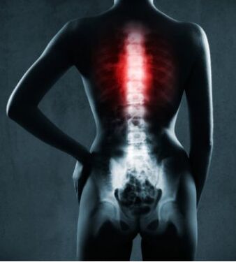 Torasik osteokondrozlu omurganın etkilenen bölgesi