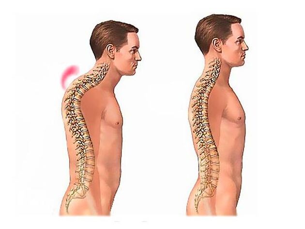 spinal kifoz