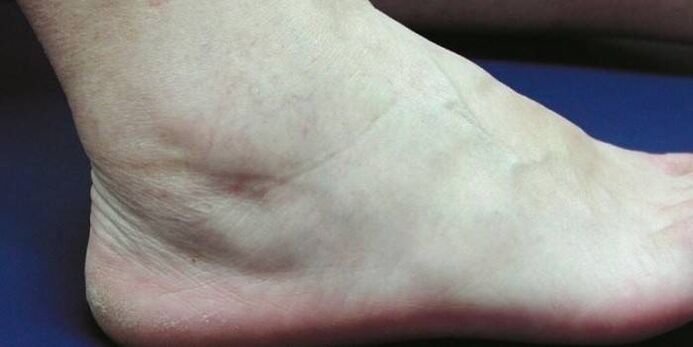 artrozlu ayak bileği şişmesi