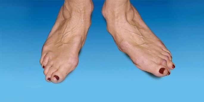 ayak bileği artrozu ile ayağın deformitesi