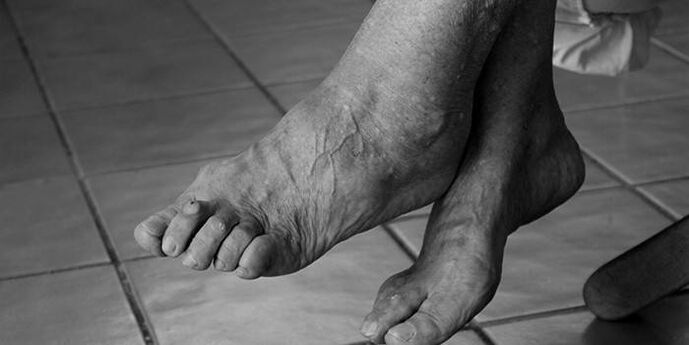 ayak bileği artrozu