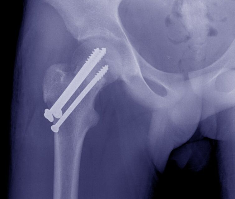 Kalça ekleminin röntgeni, iç sabitleme cihazları ile kırığın osteosentezi