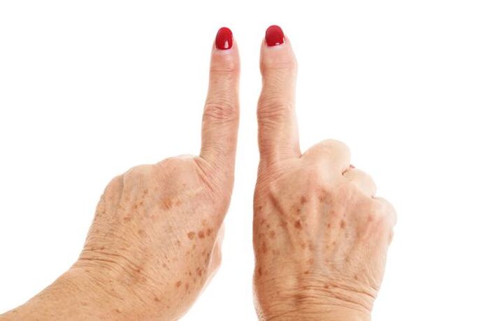 parmaklarda deforme olan artroz