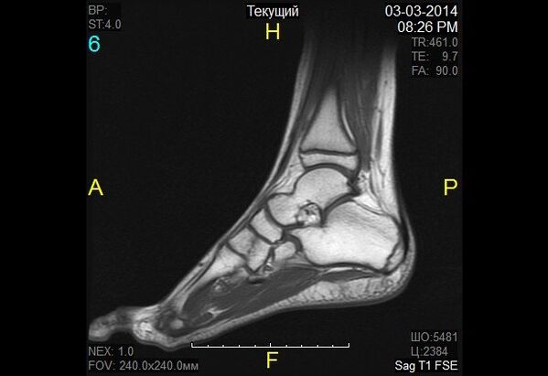 artroz için ayak bileği görüntüsü