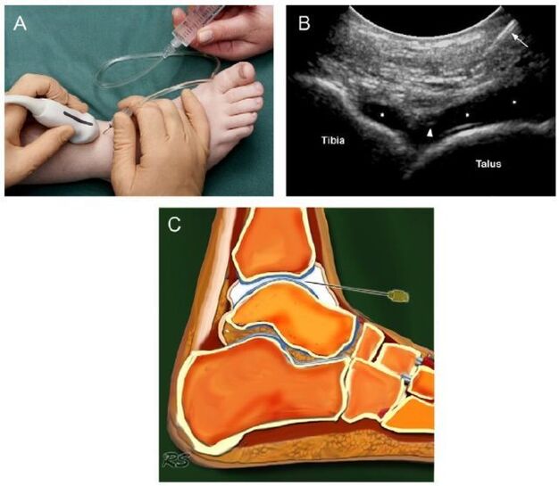 artrozlu ayak bileği ekleminin ultrasonu