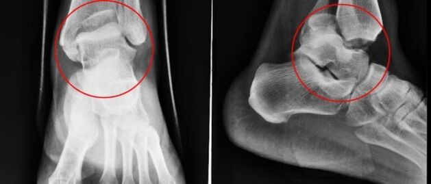 ayak bileği artrozu için radyografi