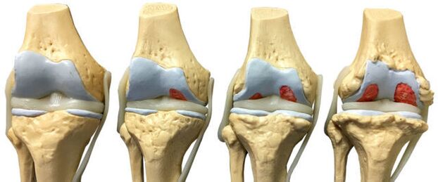 ayak bileği artrozunun gelişiminin farklı aşamalarında eklem hasarı
