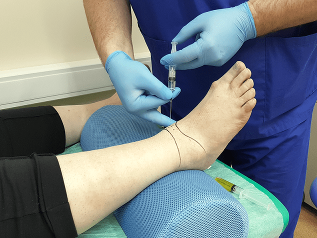 ayak bileği ekleminin artrozu için delinme