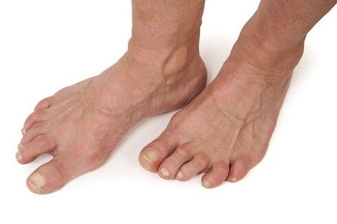 artrozdan etkilenen ayaklar