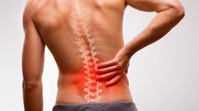 Lomber omurganın osteokondrozunun belirtileri ve semptomları